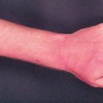 Forearm erythema related to voriconazole 1