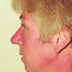 Patient AB: Voriconazole rash. Following 8 weeks of Voriconazole, patient had remarkable facial erythema, most consistent with sun exposure because of sparing of her neck.