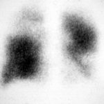 Lung perfusion scan, pt RR Technetium perfusion scan of the lungs showing left lower lobe and right upper zone defects, matching the radiological areas of abnormality. 