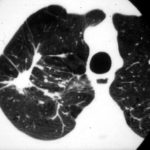 Image Image K. A CT scan section of a part of the right upper-lobe lesion shown in 2IPA9. 