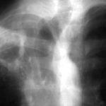 Image B. June 1992 Recurrence of disease.Chest radiograph demonstrating cavitary invasive aspergillosis.