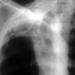 Image C. September 1992 Chest radiograph demonstrating further progression of pulmonary aspergillosis with multiple cavities in the right upper-lobe.