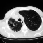 Image L. This CT scan of the thorax illustrates the formation of multiple cavities, without aspergillomas previously in ‘normal’ lung a non immunocompromised patient. The appearances are reminiscent of tuberculosis and coccidioidomycosis.