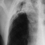 Image H. April 04 Back to where he was in terms of symptoms when he stopped itraconzole. CRP, <5, ESR 20, Aspergillus precipitins titre 1:8. Further radiological change. 