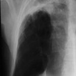 Image F. April 03 No better on itraconazole despite high concentrations of itraconazole in blood. 
