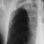 Image E. January 03 Much worse with lethargy, anorexia, weight loss and radiological deterioration on Chest Xray (link). Aspergillus precipitins rose to a titre of 1:32 , and CRP to 30, and ESR to 49. He was restarted on itraconazole.