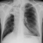 Image I. June 08 Patient remained well no cough, no sputum despite radiological signs.