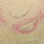 Image D.  Lung biopsy - Low power elastin stain of right lung showing preservation of the normal elastin fibres around a small artery, but loss of elastin around a small bronchus, indicating bronchial destruction. - 3/11/98 -  