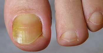 Image 5. A 66 yr old patient in good general health developed onychomycosis. Samples taken from the affected nail were grown by culture and examined by microscopy. 