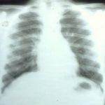 Image E. Chest X-ray showing progression of infiltrates, despite azithomycin and itraconazole. She subsequently responded to large doses of corticosteroids. 3/11/98 