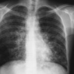 Image 6. Mar 12th Chest x-ray just before discharge from hospital or oral voriconazole showing marked improvement, but residual disease especially in the left lower lung behind the heart, with some suggestion of bronchiectasis in this area.