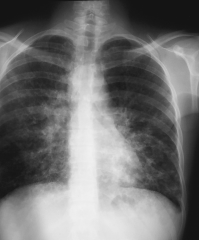 Image 6. Mar 12th Chest x-ray just before discharge from hospital or oral voriconazole showing marked improvement, but residual disease especially in the left lower lung behind the heart, with some suggestion of bronchiectasis in this area.
