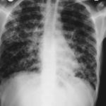 Image 3. Feb 14th Six days later he was clinically improved, having required three days of nasal CPAP and voriconazole. 