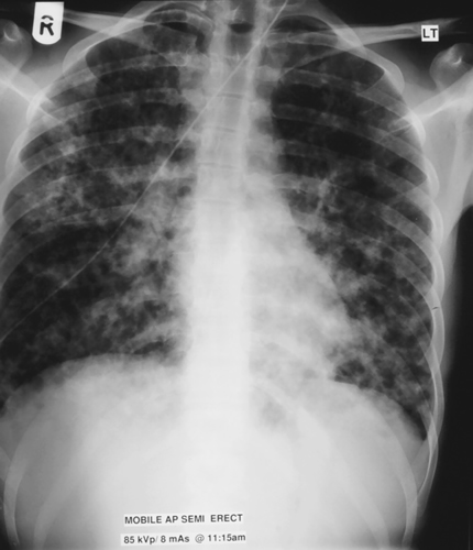 Image 3. Feb 14th Six days later he was clinically improved, having required three days of nasal CPAP and voriconazole. 