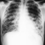Image 5. Feb 19th Chest x-ray showing apparent worsening of the left lower zone, but improvement in the upper zone. 