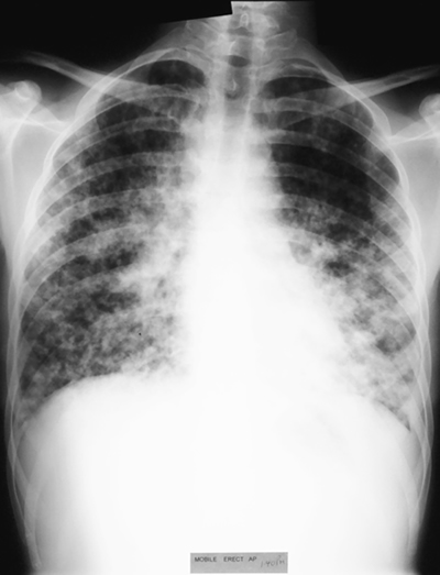 Image 5. Feb 19th Chest x-ray showing apparent worsening of the left lower zone, but improvement in the upper zone. 