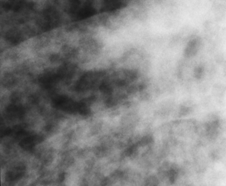 Image 2. Feb 8th Close up of the right lung showing multinodular pattern.