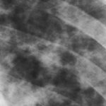 Image 4. Feb 14th Close up of the left lung field showing some small and other large coalescing nodules.
