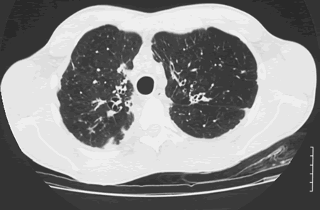 Image B. Bilateral multilobar bronchiectasis with surrounding peribronchial oedema and some evidence of inhomogeneity of the pulmonary parenchyma on the left, with hyperexpansion, indicating chronic air trapping in the left upper lobe particularly.