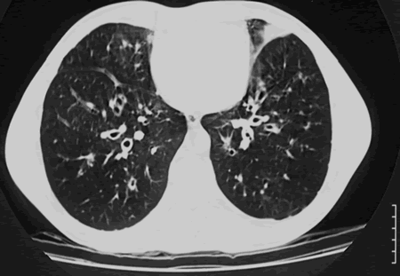 Images C & D. Bilateral bronchiectasis in the context of corticosteroid dependant ABPA, which improved markedly with oral itraconazole therapy.