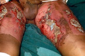 This photo shows extensive infection of the burn wound on the leg of a 7 year old boy, acquired about 3 weeks after the injury. Despite medical therapy he died.