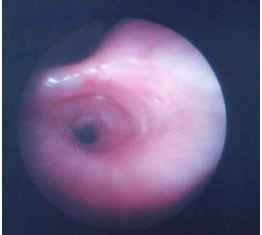 After removal of the plug the orifice of the right middle lobe appeared clear but was erythematous.