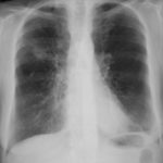 Image 1 24/05/07 Chest X ray showing a solitary nodule in right upper lobe, for which a sub-lobar wedge resection was done