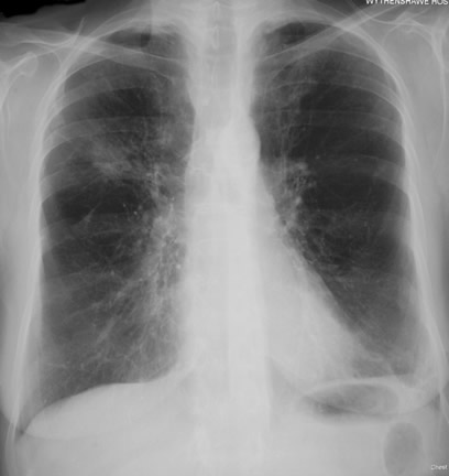 Image 1 24/05/07 Chest X ray showing a solitary nodule in right upper lobe, for which a sub-lobar wedge resection was done