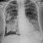  Image 4 06/08/07 CXR showing extension of consolidation to both lung bases and right basal pneumothorax despite antibiotics and itraconazole. 