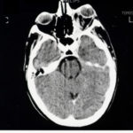 Image B. Lower CT scan image again showing marked proptosis and complete opacification of the apex of the orbit with inflammatory material. The sinuses are clear. 