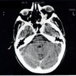 Image C. Lower CT scan image again showing inflammatory material at the apex of the orbit, without involvement of the sinuses.
