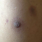 Bullous lesions on the skin of the patient with acute myelogenous leukemia during the febrile neutropenia attack.