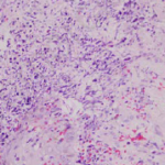 Histological findings of invasive cutaneous aspergillosis. Skin biopsy showing fungal hyphae accumulated in the dermiş.