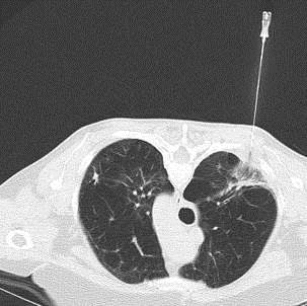 Evaluating CT guided lung biopsies for diagnosing fungal infection