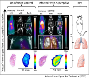 Aspergillus diagnostics immunopet scan
