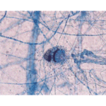 Chronic invasive sinus aspergillosis caused by Aspergillus terreus