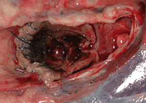 Fatal haemoptysis post lung-transplant (left main bronchus)