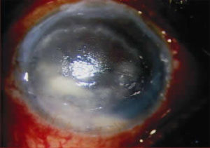Infection following amniotic membrane transplantation (AMT) for bullous keratopathy. Picture shows slit-lamp photograph of left eye showing ring shaped stromal infiltrate. This 55-year-old female underwent AMT with epithelial debridement and anterior stromal puncture in the left eye. She developed fungal keratitis after 4 weeks. Aspergillus sp. was isolated from the corneal scraping. The patient was treated with systemic and topical antifungal medication.