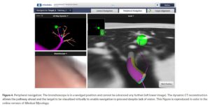 electromagnetic navigation bronchoscopy