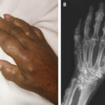 Voriconazole-induced periostitis
